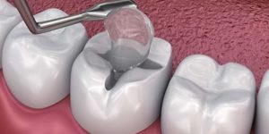 پرکردن دندان با مواد سفید