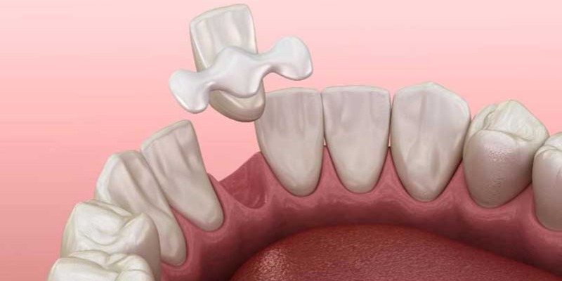 منظور از بریج دندان چیست