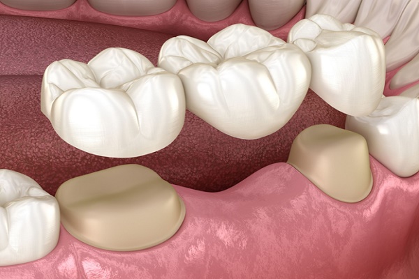 بریج دندان یا دندان مصنوعی پانتیک 