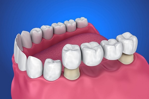 میزان دوام بریج دندان