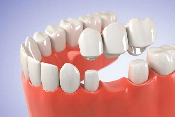 عوامل موثر بر هزینه بریج دندان