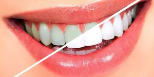 معرفی روش های روشن کردن دندان