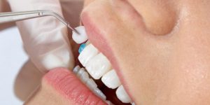 بررسی معایب لمینت دندان