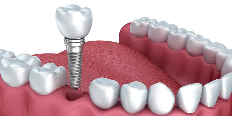 ایمپلنت دندان چیست و چگونه انجام می شود؟
