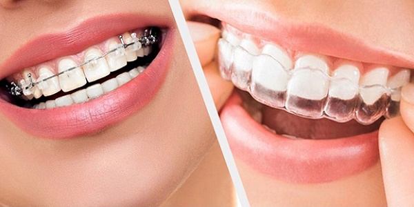 مراقبت از دندان ها در ارتودنسی