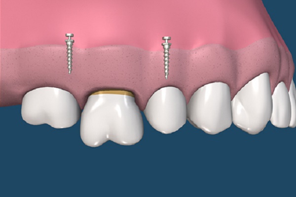 ارتودنسی بدون جراحی ایمپلنت دندان