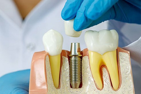 منظور از ایمپلنت دندان چیست
