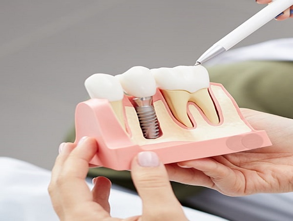 ایمپلنت دندان چیست و چگونه انجام میشود