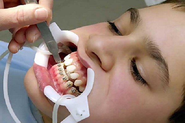 بررسی مرحله بریس های دندانی در ارتودنسی