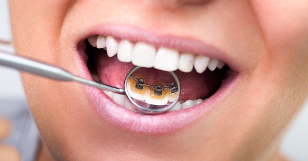 مزایای بریس ها و ارتودنسی دندان