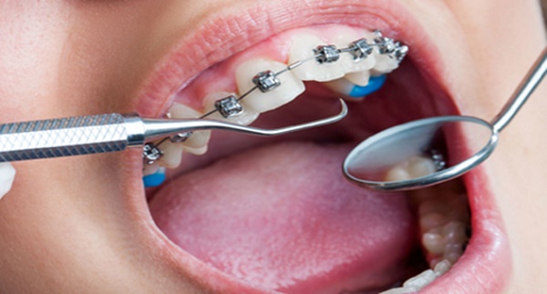 مشکل اصلاحی با ارتودنسی دندان 