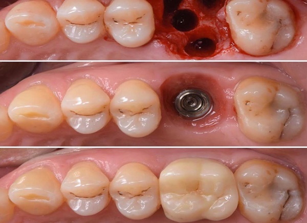 دندان ایمپلنت چیست