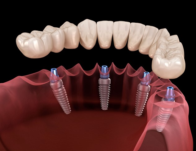 پروتزهای دندان