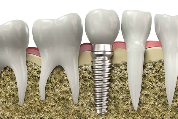 جراحی ایمپلنت دندان چگونه است