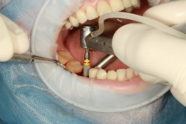 ایمپلنت دندان یعنی چه