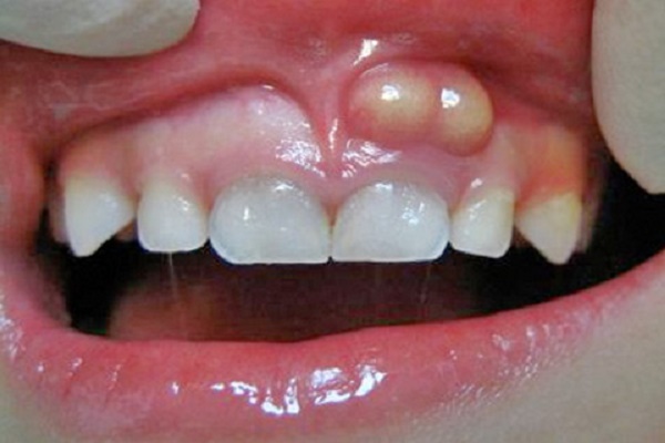 نشانه های آبسه دندان