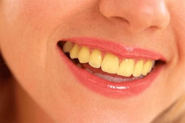 تاثیرات بیماری بر زرد بودن دندان ها 