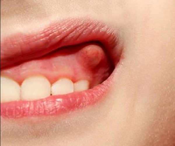 داروهای لازم درمان آبسه دندان