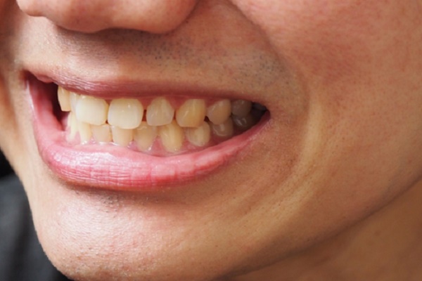 زرد بودن دندان ها و مصرف آنتی بیوتیک