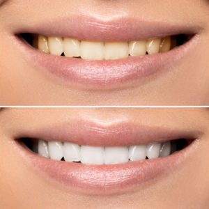 سفید سازی دندان