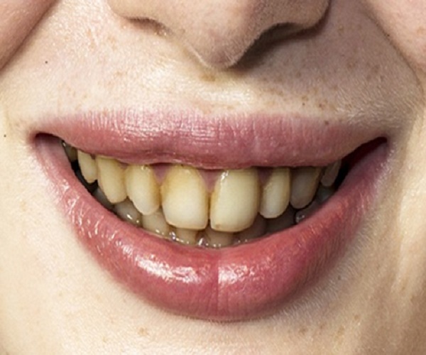 علت زرد بودن دندان ها و رعایت نکردن بهداشت دهان و دندان