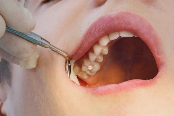 مراحل مختلف پر کردن دندان