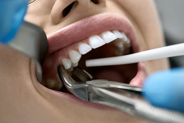 مزایای برداشتن دندان آسیب دیده