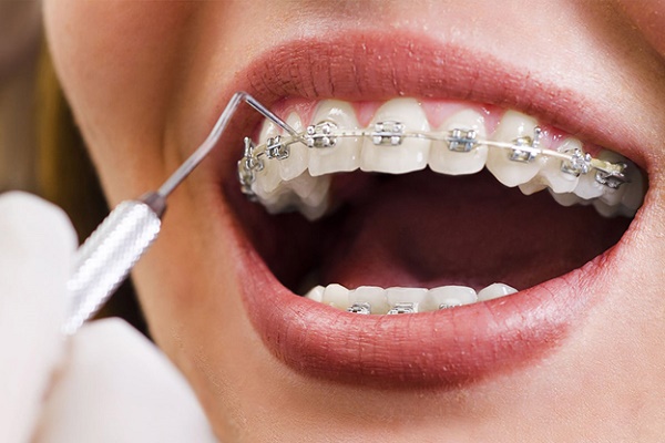 ارتودنسی دندان - کلینیک بام