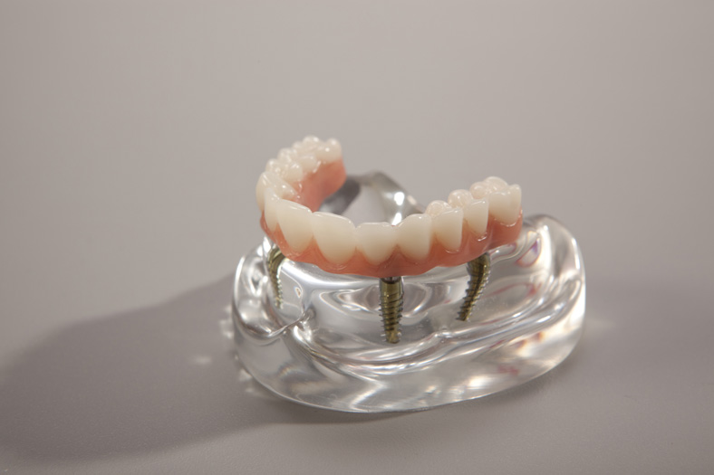 اوردنچر نوعی از پروتز دندان متحرک