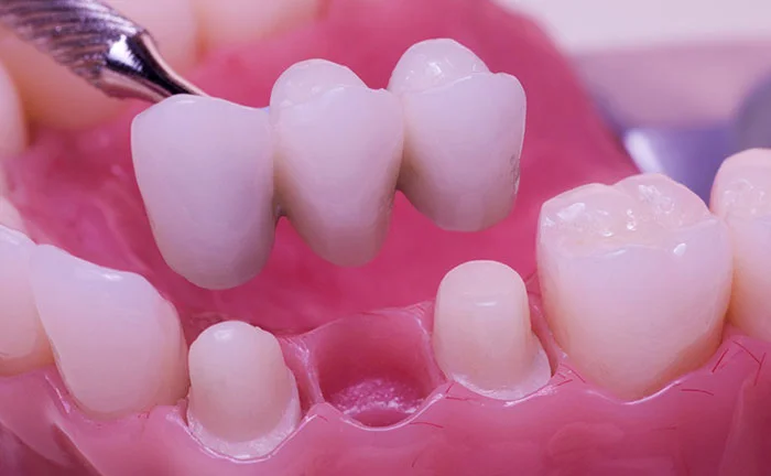 معرفی و بررسی انواع پروتز های دندان