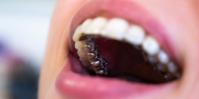 ارتودنسی پشت دندانی چیست