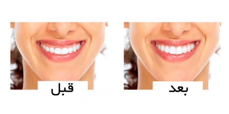 عکس قبل و بعد از اصلاح طرح لبخند - کلینیک بام